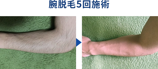 腕脱毛