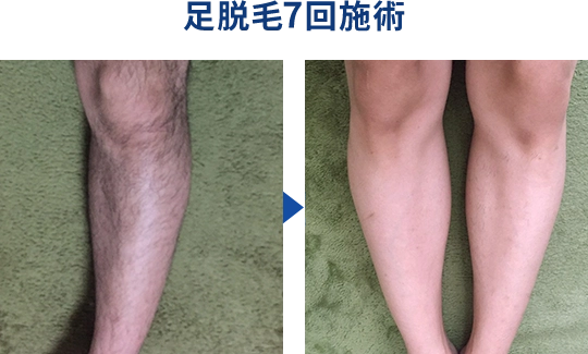 足脱毛
