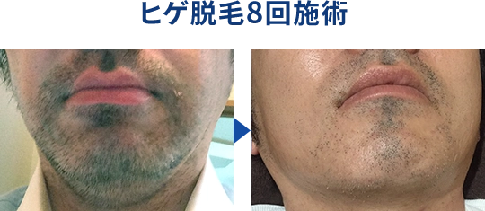 ヒゲ脱毛