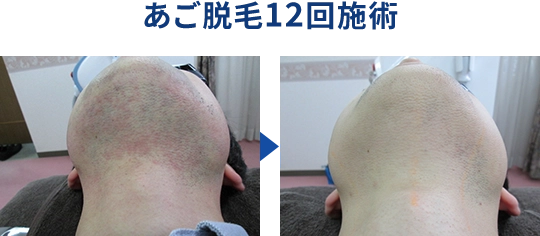 あご脱毛